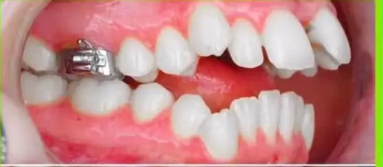 Inicio del tratamiento: dientes apiñados de perfil