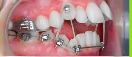 Mitad del tratamiento con brackets y elásticos