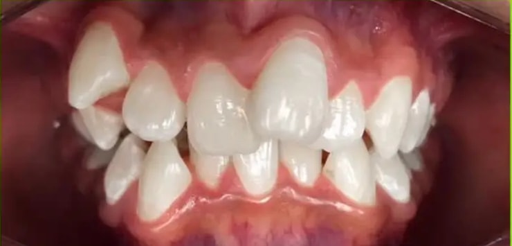 Dientes desalineados antes de la ortodoncia