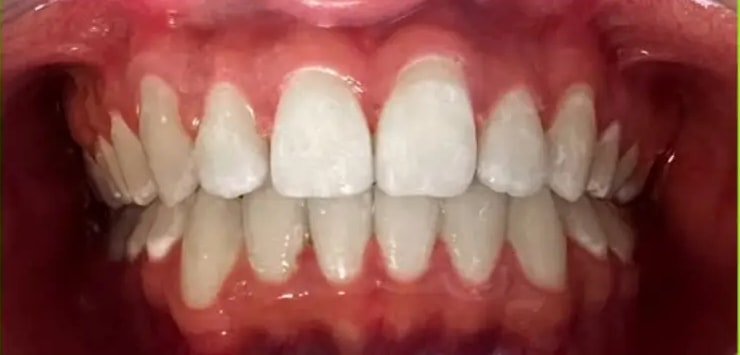 La misma sonrisa alineada tras el tratamiento