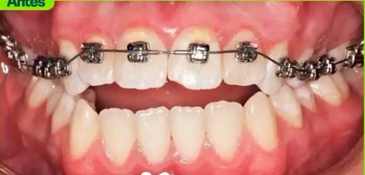 Dientes con espacios y desalineados durante la ortodoncia